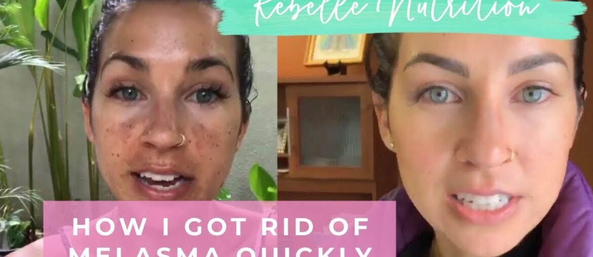 HOW I HEALED MY MELASMA/DARK SPOTS QUICKLY - REBELLE NUTRITION