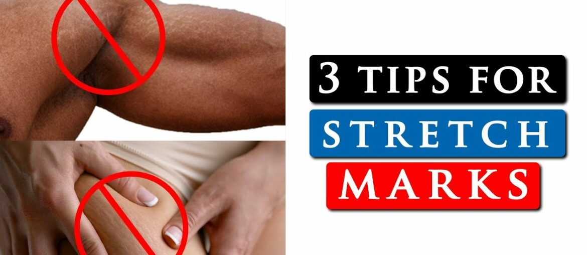 How to get rid of STRETCH MARKS on your SHOULDERS, LEGS & STOMACH