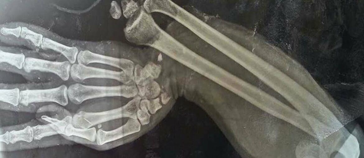 A Boy Ate 150 Gummy Vitamins For Breakfast. This Is What Happened To His Bones.