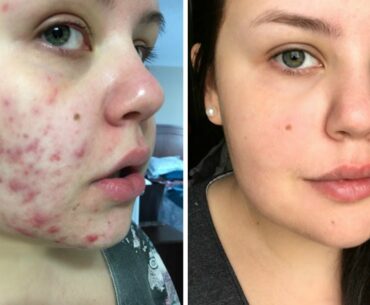 3 PRODUCTS THAT TRANSFORMED MY SKIN | Acne Scarring