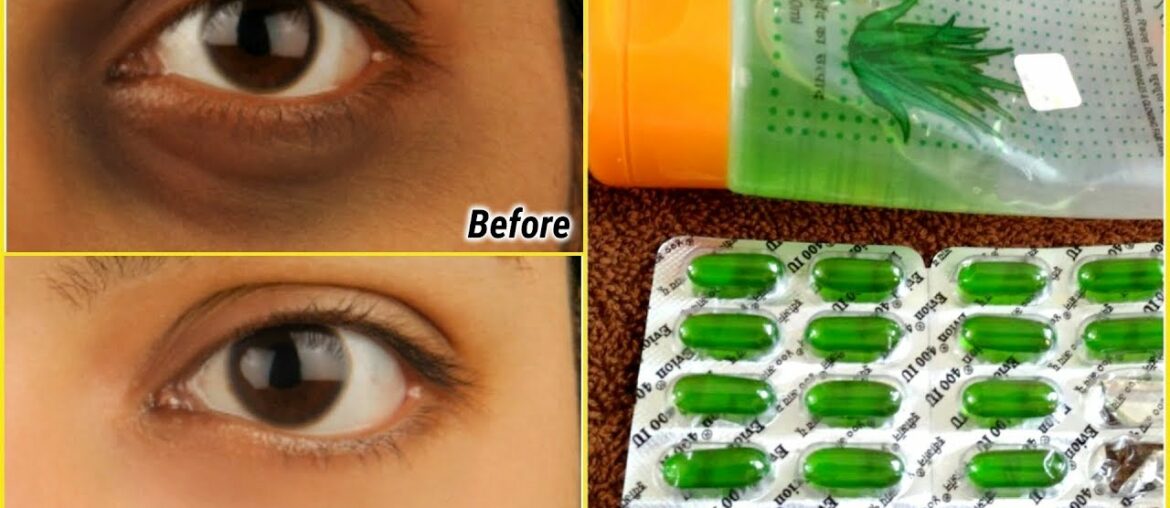 use vitamin E oil & aloevera gel to remove dark circles permanently