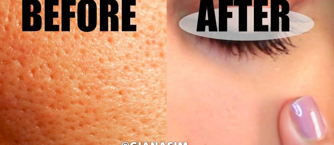 D.I.Y - Get rid of LARGE Pores NATURALLY! IT WORKS!