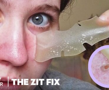 Overnight Pore Strips Absorb Excess Sebum | The Zit Fix