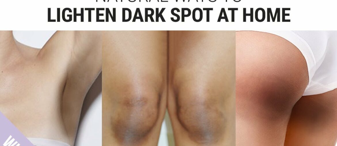 How To Lighten Dark Underarms, Knees & Elbows | Skin Brightening Tips for Dark Spot