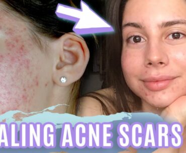 HEALING SCARS OVERNIGHT || MY ACNE SCAR EVENING SKINCARE ROUTINE 2020!!