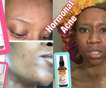 My morning skin care routine fading hyperpigmentation scars and treating hormonal acne| The Ordinary