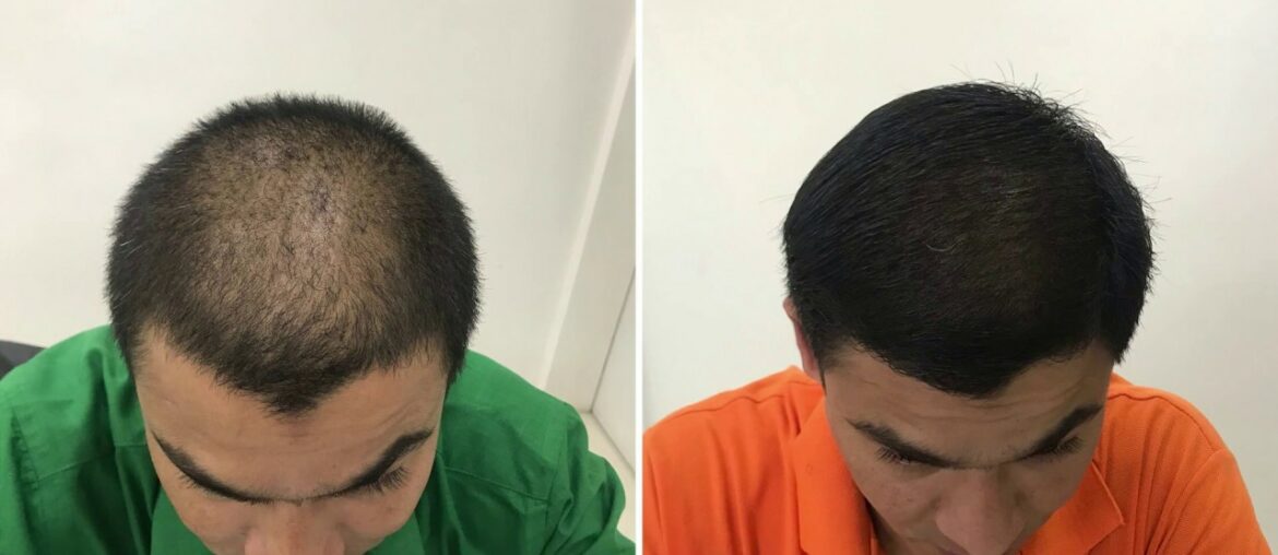 Hair Growth Treatment | Nutritional Cyclical Therapy Results| Call 8530090333 | MaxDense Hair Clinic