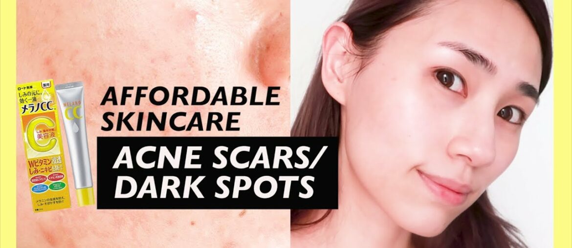 Affordable Skincare for Acne Scars, Dark Spots, Pores & Brighter Skin!