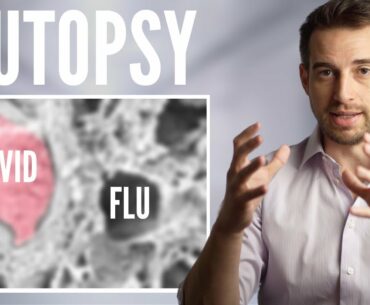 Autopsy Comparison - Coronavirus vs Flu vs Normal Lungs