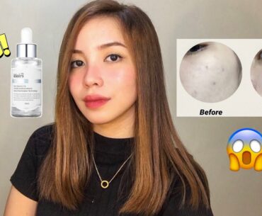 PAANO NAWALA PIMPLE MARKS KO?? | Klairs freshly juiced vitamin drop & unscented toner