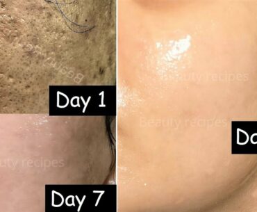 15 Days Skin Repair | Close Large OPEN PORES & Remove Dark Spots - RiceWater Icecubes & Vitamin C