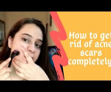 How to get rid of acne scars completely