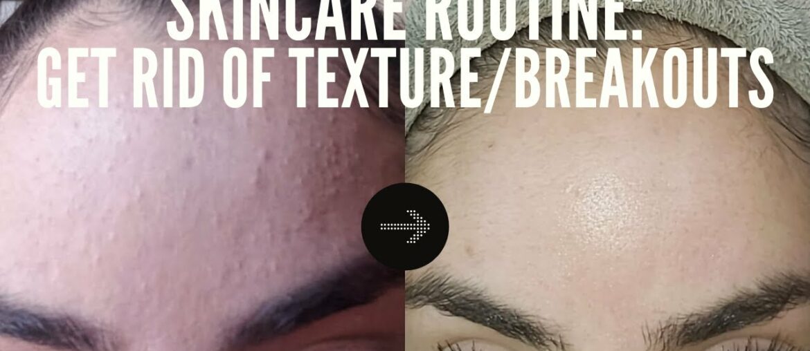 HOW TO GET RID OF TEXTURED SKIN / MILD ACNE / FUNGAL ACNE / REGULATE HORMONAL BREAKOUTS / B3 & B5