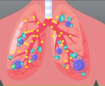 How COVID-19 attacks the body and why it impacts some more than others