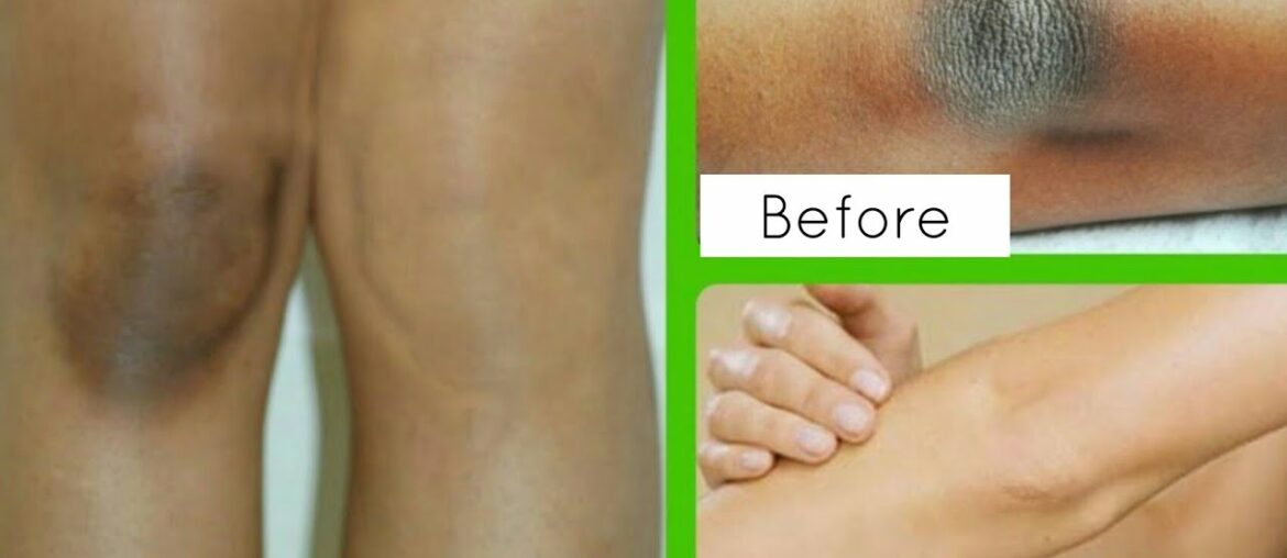 How To Lighten Dark Elbows, Knees & Underarms with Vitamin E Oil