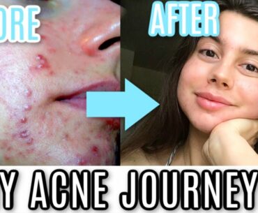 MY ACNE JOURNEY STORY || HOW I CLEARED MY SKIN, EVERYTHING YOU NEED TO KNOW.