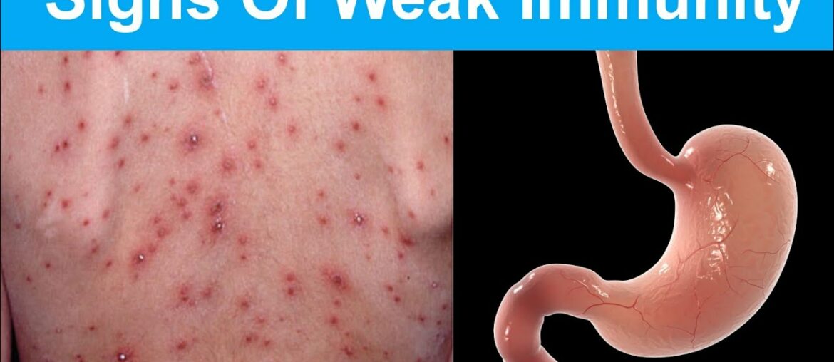 10 Warning Signs Of Weak Immunity You shouldn't Ignore