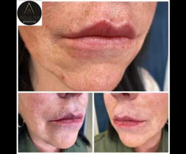 Lip Augmentation: Second session