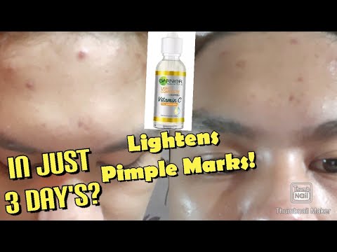 Pampaalis ng Dark Spots at Pimple Marks!/Garnier Vitamin C Serum Honest Review/Raquel Pinca