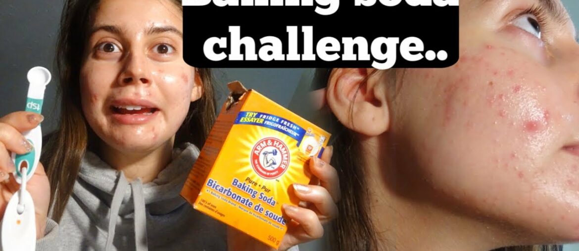 ACNE IS CAUSED BY LOW STOMACH ACID!? || BAKING SODA CHALLENGE TEST FOR MY STOMACH ACIDS..