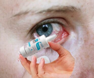 Bacterial Conjunctivitis | Bacterial Eye Infection Natural Treatment