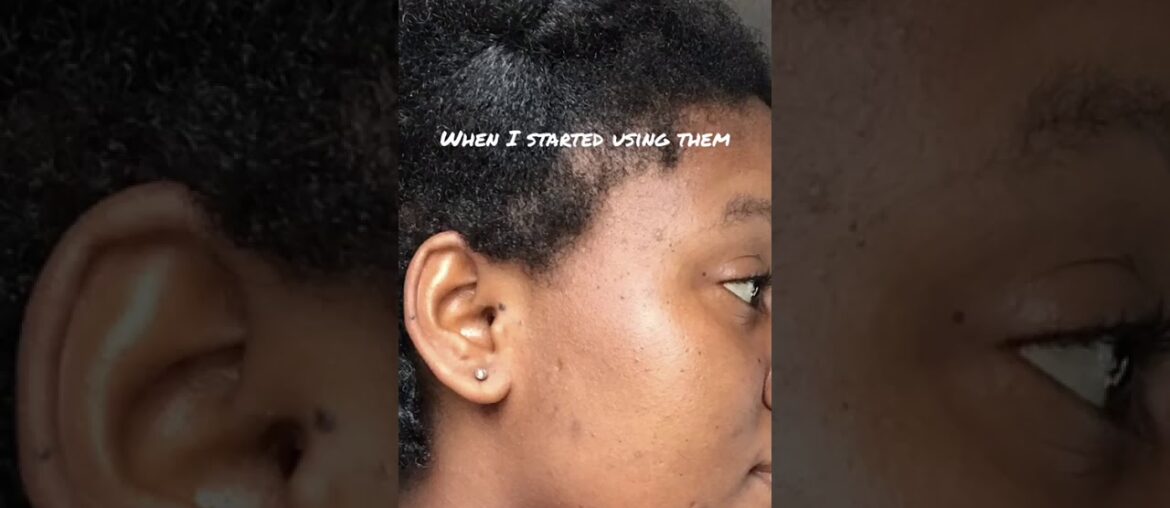 Before and After 1 month of using Chuarme Hydrating Mist Coco Oil X Rose Vitamin C 2 in 1 MASK