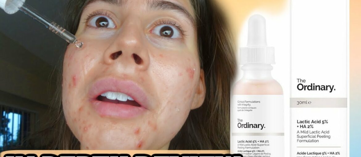 I TESTED THE ORDINARY LACTIC ACID FOR MY ACNE SCARS FOR 3 WEEKS.. THIS IS WHAT HAPPENED.