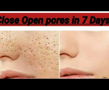 Close Open pore in 7 days.Shrink open pores. Divyalifestyle.Divya beauty hub.close open pores 2 days