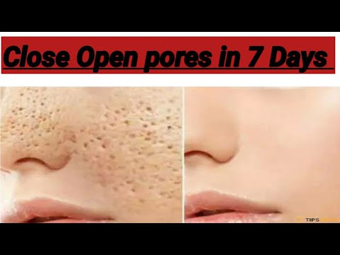 Close Open pore in 7 days.Shrink open pores. Divyalifestyle.Divya beauty hub.close open pores 2 days