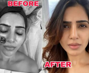 Actress Samantha Akkineni Reveals Her Glowing Skin Secret | Vitamin Infusion Therapy | IB9TV