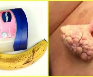 HOME REMEDY HOW TO  Remove skin TAGS EASILY AT HOMES,JUST 3 INGREDIENTS, RESULT AFTER 1 NIGHT