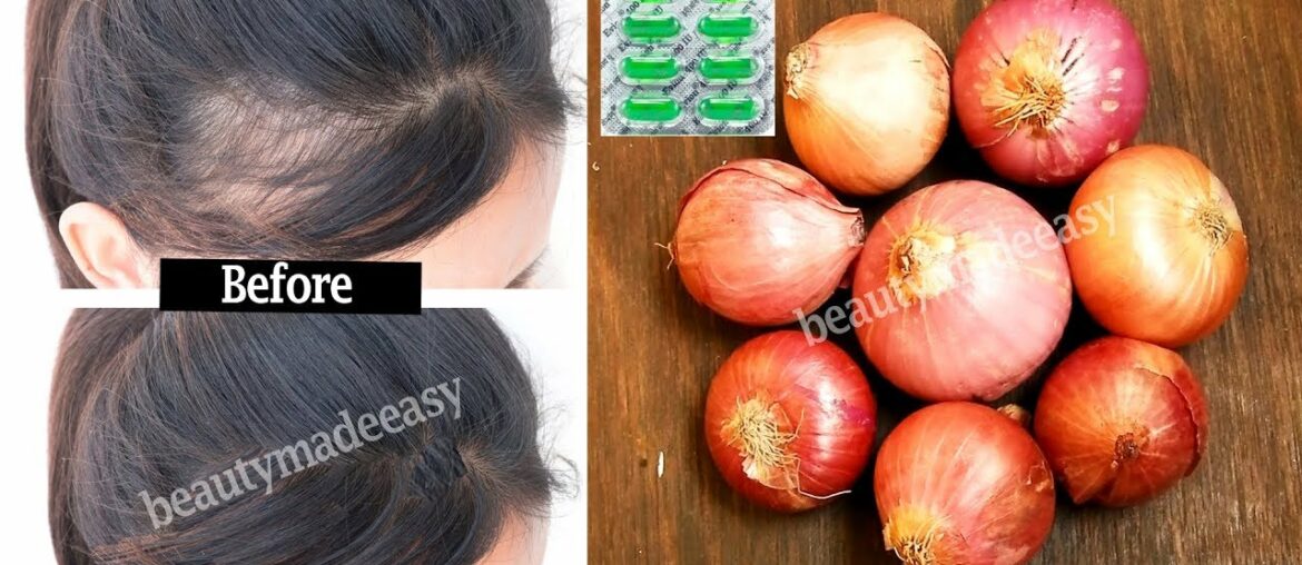 Regrow Your Hair with Onion and Vitamin E | Stop Hair Fall Quickly | 100% working Both Men & Women