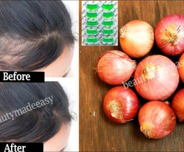Regrow Your Hair with Onion and Vitamin E | Stop Hair Fall Quickly | 100% working Both Men & Women