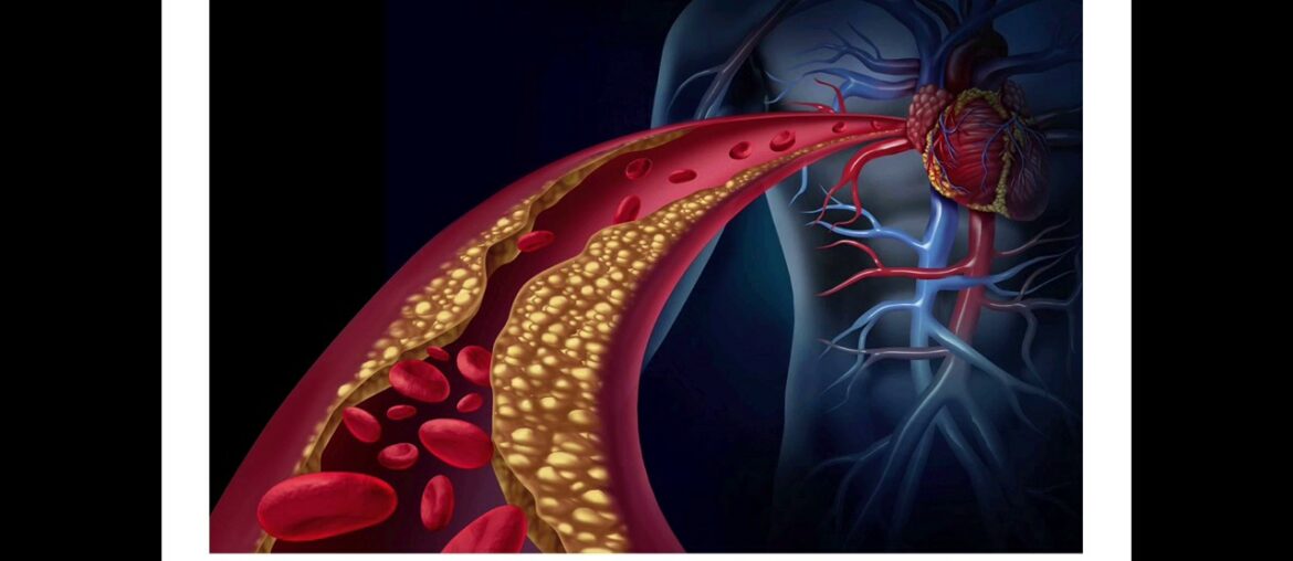 Taking Vitamin D and Calcium Without K2 Can Increase Heart Attack Risk