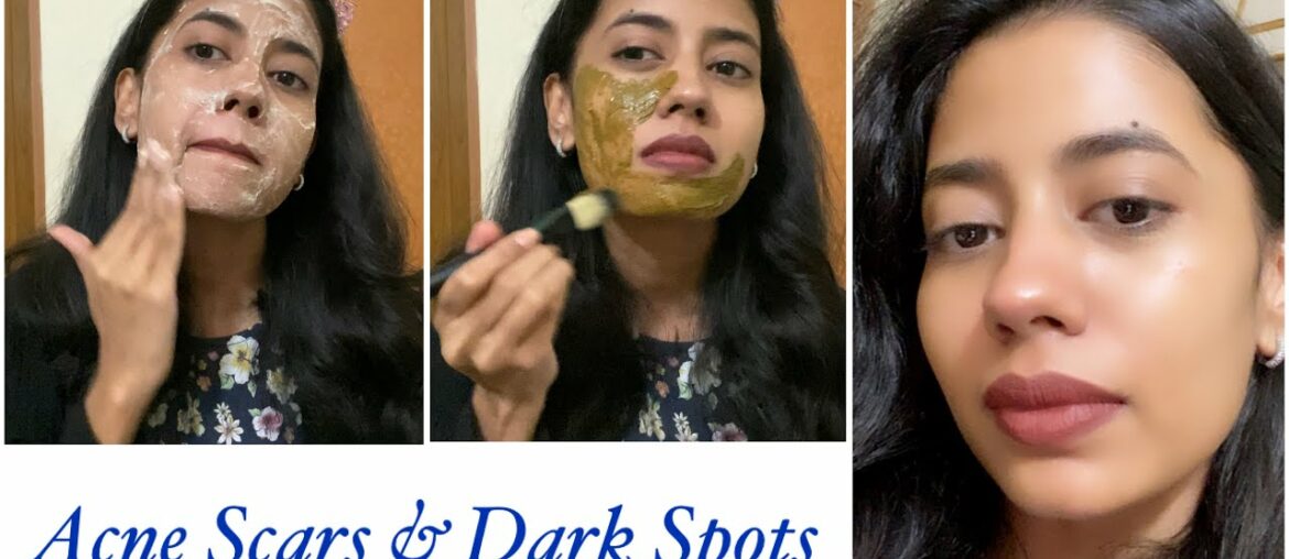 Remove Acne Scars, Dark Spots and Discoloration Naturally with this Routine