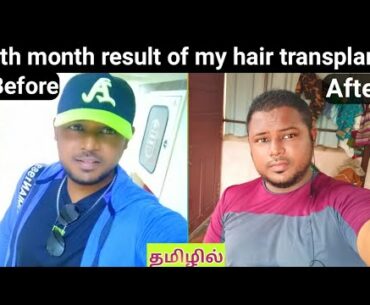 4 months result of my hair transplant / hair transplant in Tamil / result of hair transplant