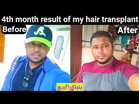 4 months result of my hair transplant / hair transplant in Tamil / result of hair transplant