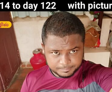 hair transplant result day 114 to day 122 / hair transplant Tamil / sarvan Tamil