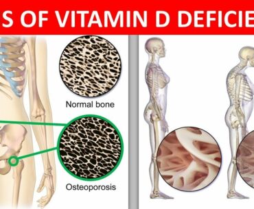 Warning Signs of Vitamin D Deficiency