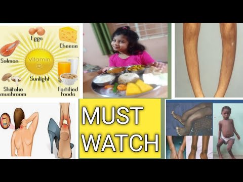 #vitamind | why VITAMIN D is so important.. how does it save us from #coronavirus... MUST WATCH