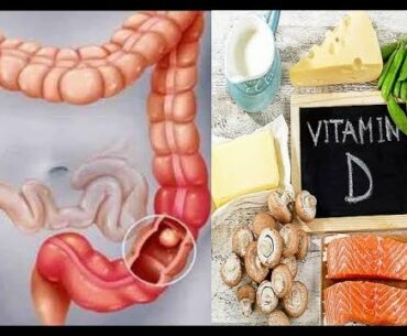 Higher vitamin D levels cut colorectal cancer risk by 31%