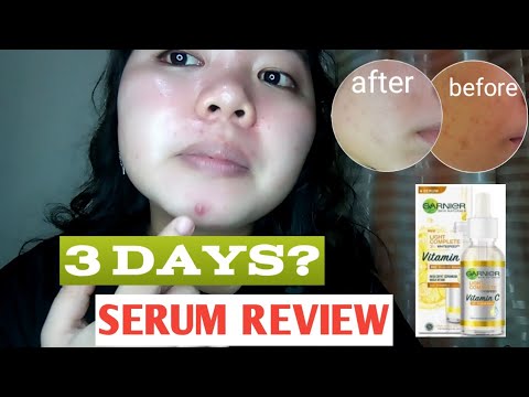 TANGGAL DARK SPOTS AT PIMPLE MARKS | GARNIER VITAMIN C SERUM REVIEW