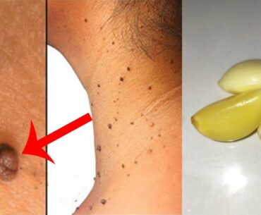 How to remove skin tags naturally fast with garlic and vitamin - Remove skin tags