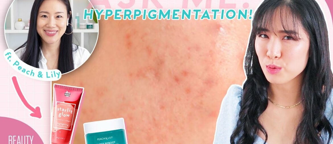 How to Brighten Dark Spots, Acne Marks & Hyperpigmentation ft. @Peach & Lily