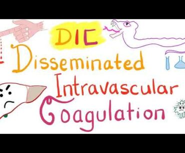 Disseminated Intravascular Coagulation (DIC)