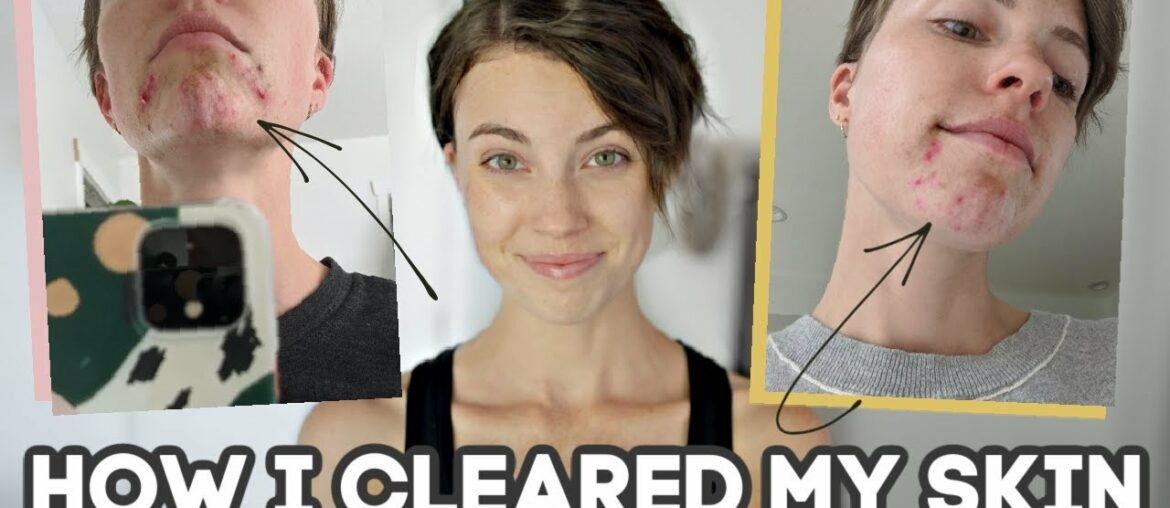How I Cleared My HORMONAL ACNE Naturally (10+ years of acne...)