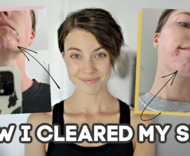 How I Cleared My HORMONAL ACNE Naturally (10+ years of acne...)