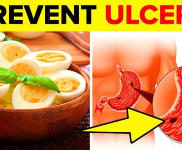 11 Best Foods To Prevent Ulcers