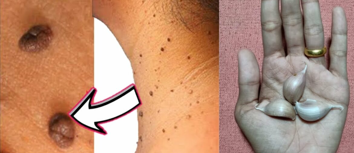 How to remove skin tags naturally fast with Garlic and Vitamin-E | Remove skin tags at home