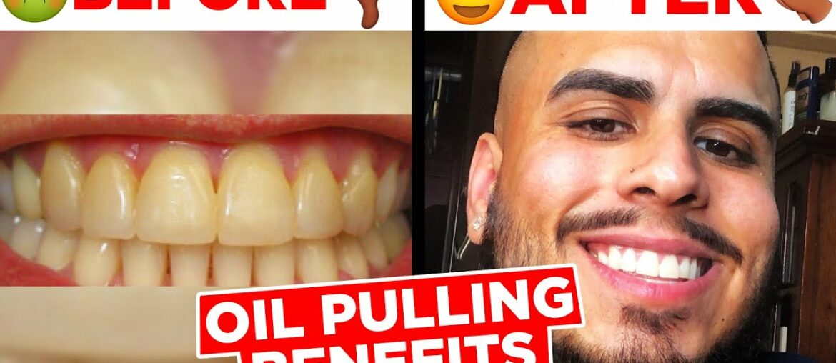 WHITEN YOUR TEETH FAST WITH OIL PULLING! #teethwhitening